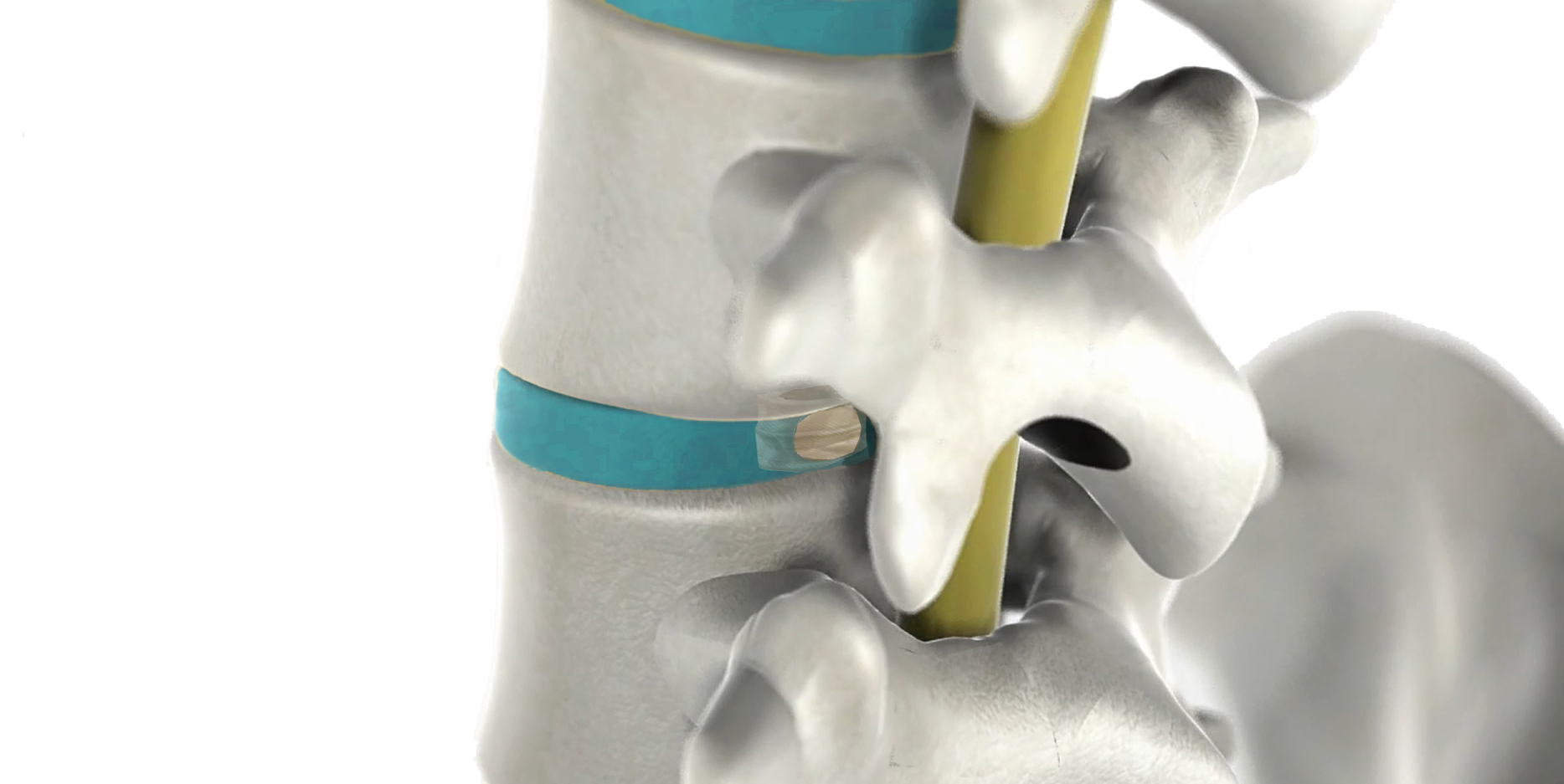 DISC care™_NEOS Surgery